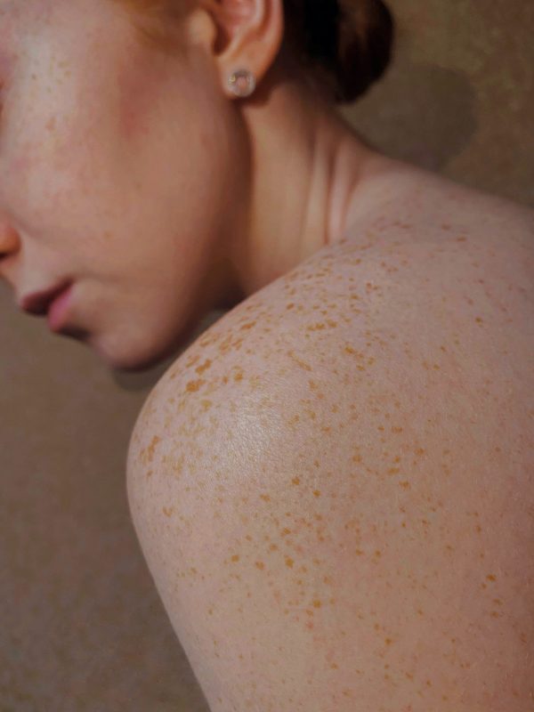 skin, psoriasis, the woodlands, houston, texas, theramineral